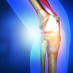 5 Questions to Ask Before Knee Replacement Surgery